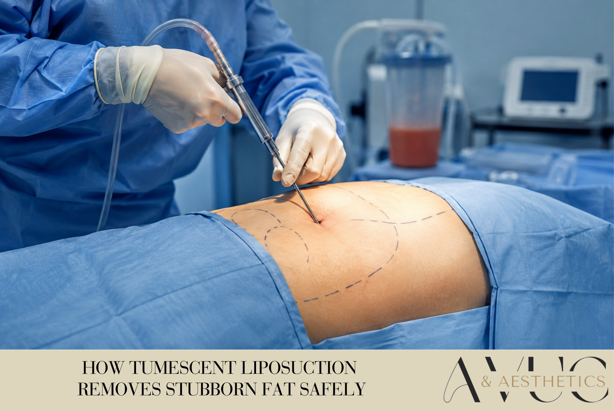 How Tumescent Liposuction Removes Stubborn Fat Safely