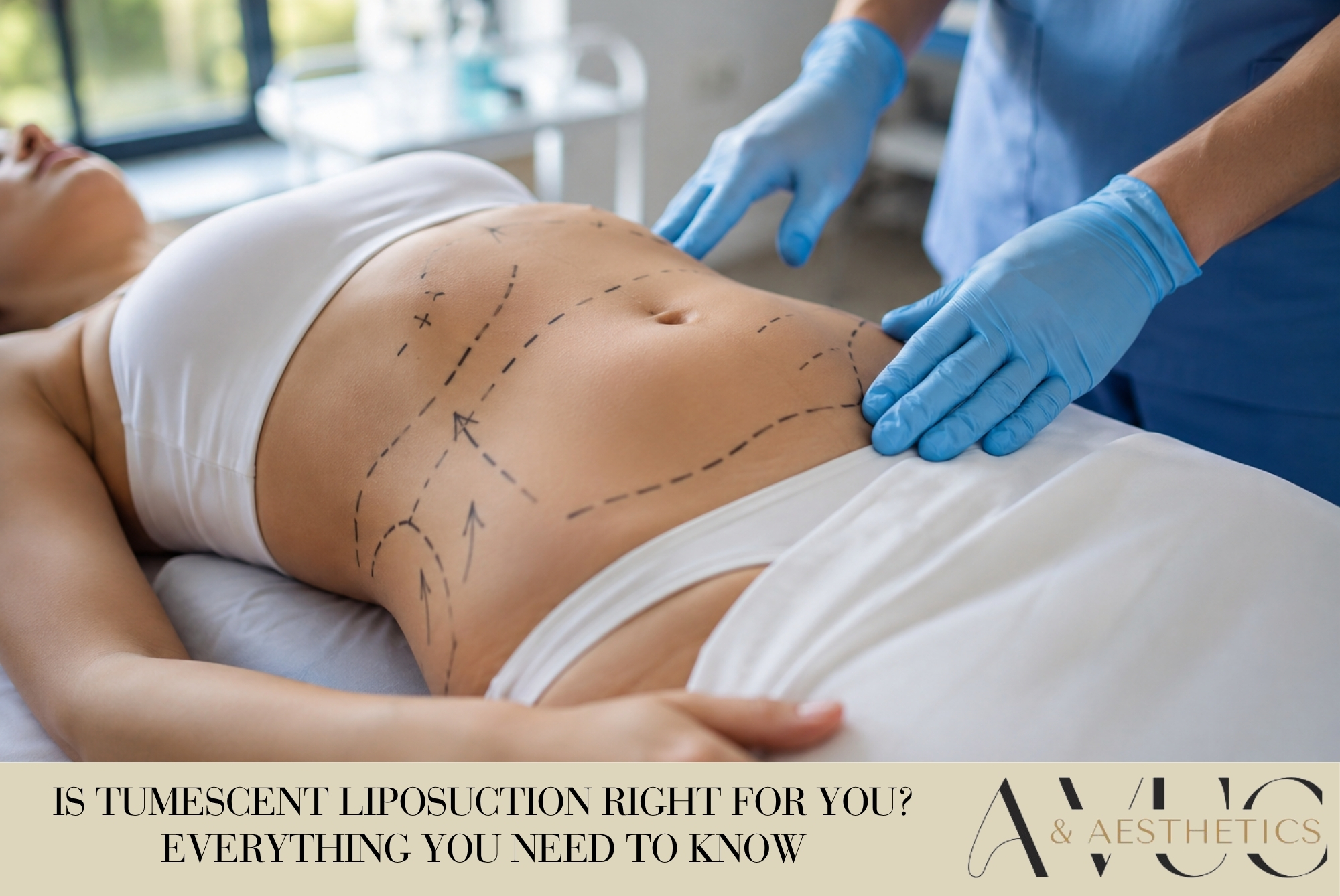 Is Tumescent Liposuction Right for You? Everything You Need to Know