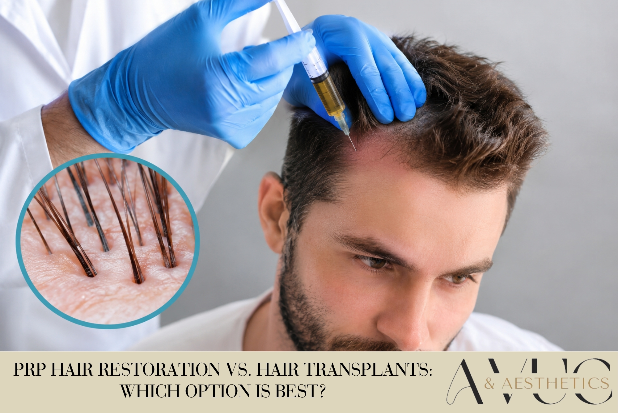 PRP Hair Restoration vs. Hair Transplants: Which Option Is Best?
